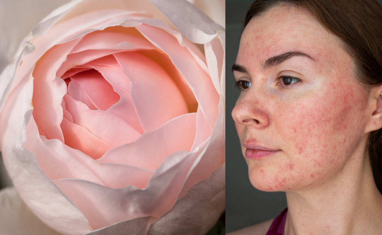Rosacea Symptoms with Natural Remedies | Get Rid of Rosacea – Potion