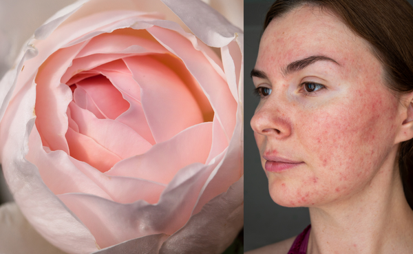 Taking Control of Your Rosacea Symptoms with Natural Remedies