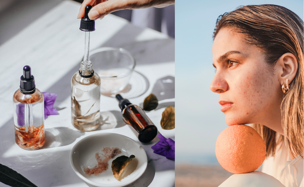 Say Goodbye to Acne Scars with these Natural Remedies and Professional Treatments