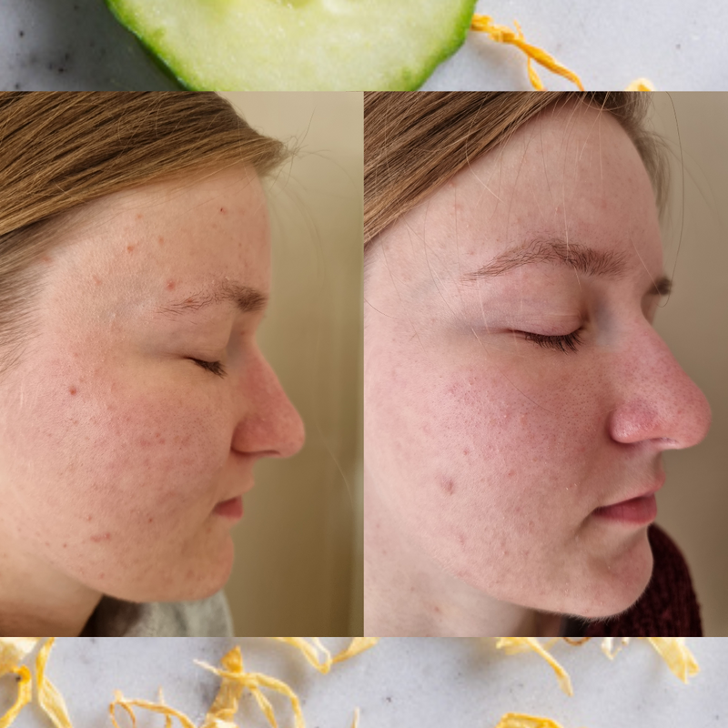 natural acne treatment before and after photo, on spot acne treatment
